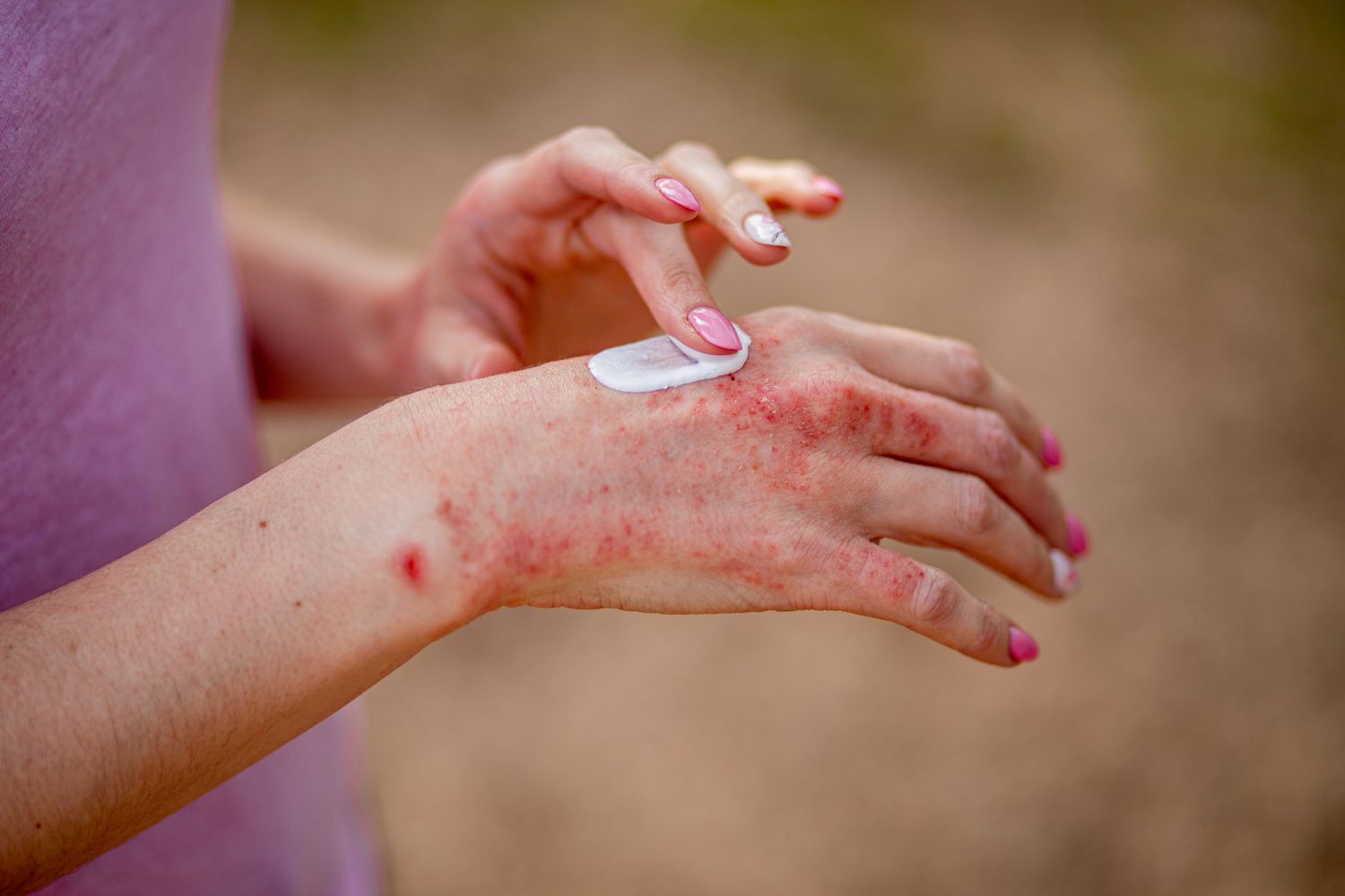 eczema