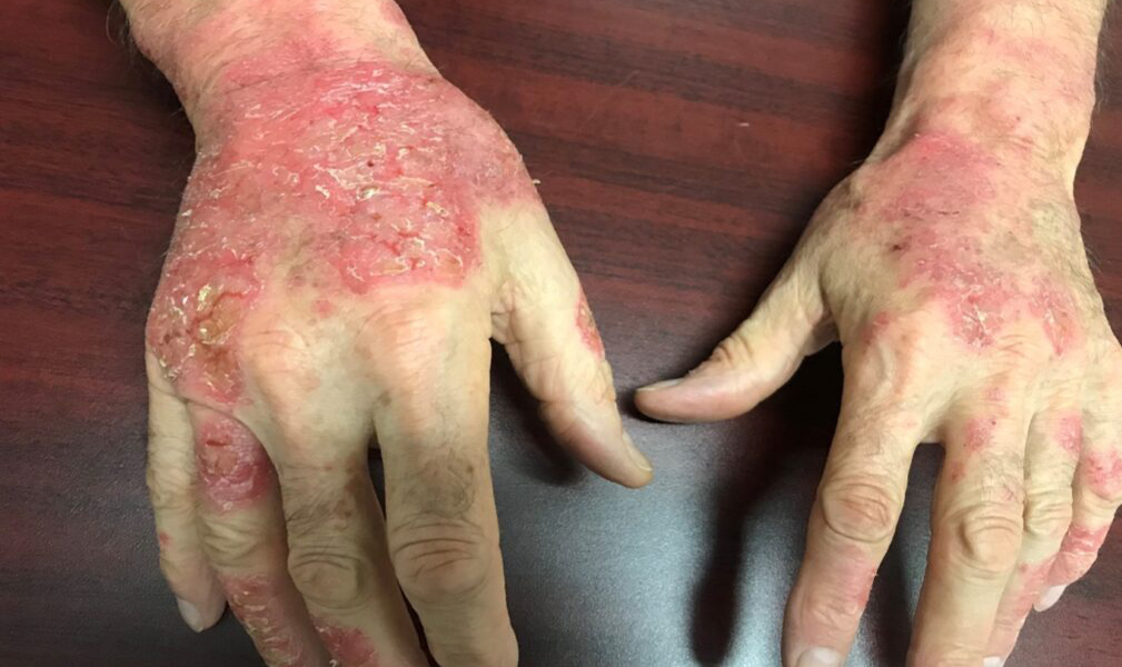 dermatitis