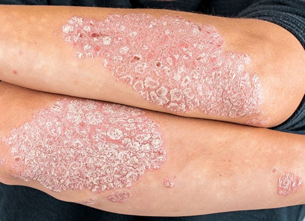 psoriasis