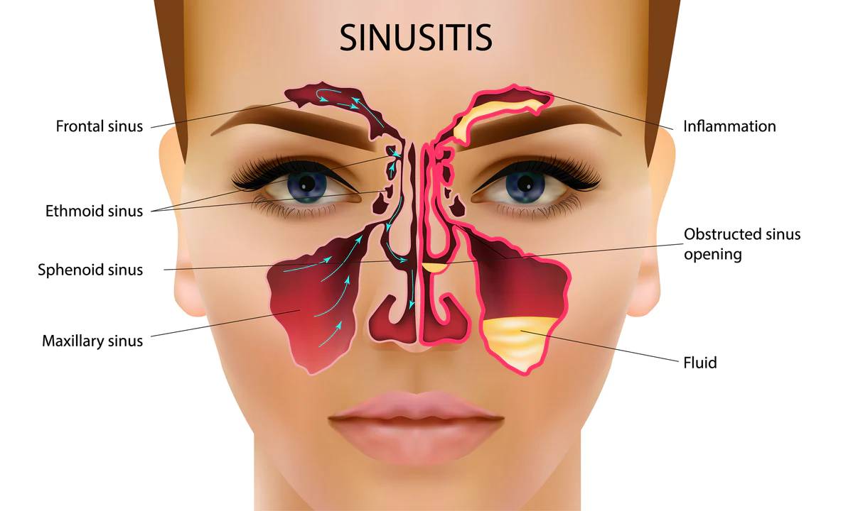 sinusitis